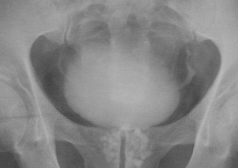 radiografie pentru prostatită