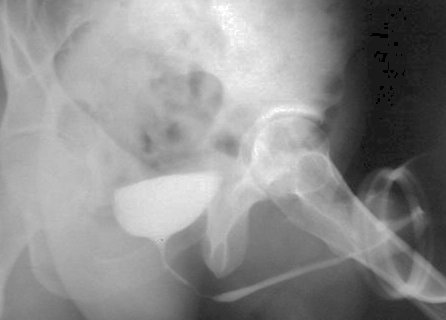 radiografie pentru prostatită sangerare urinare barbati