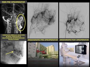 Premieră: procedură de embolizare a unei malformații arteriovenoase faciale de mari dimensiuni